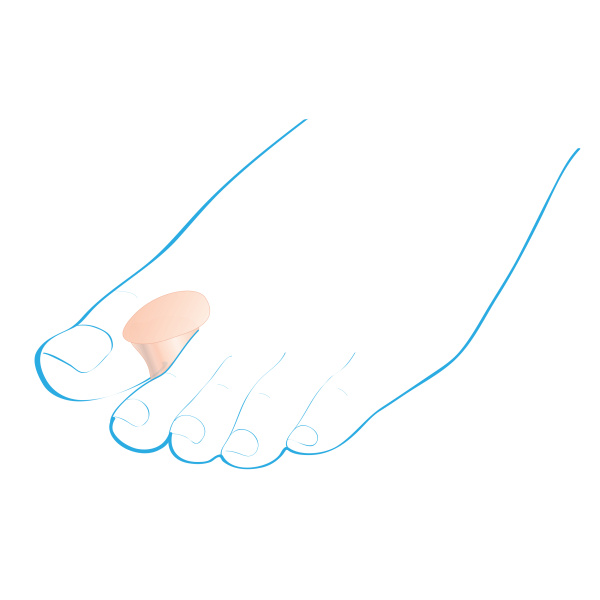 Межпальцевые ортопедические разделители Крейт C-402 фото в интернет-аптеке "Фармсервис"